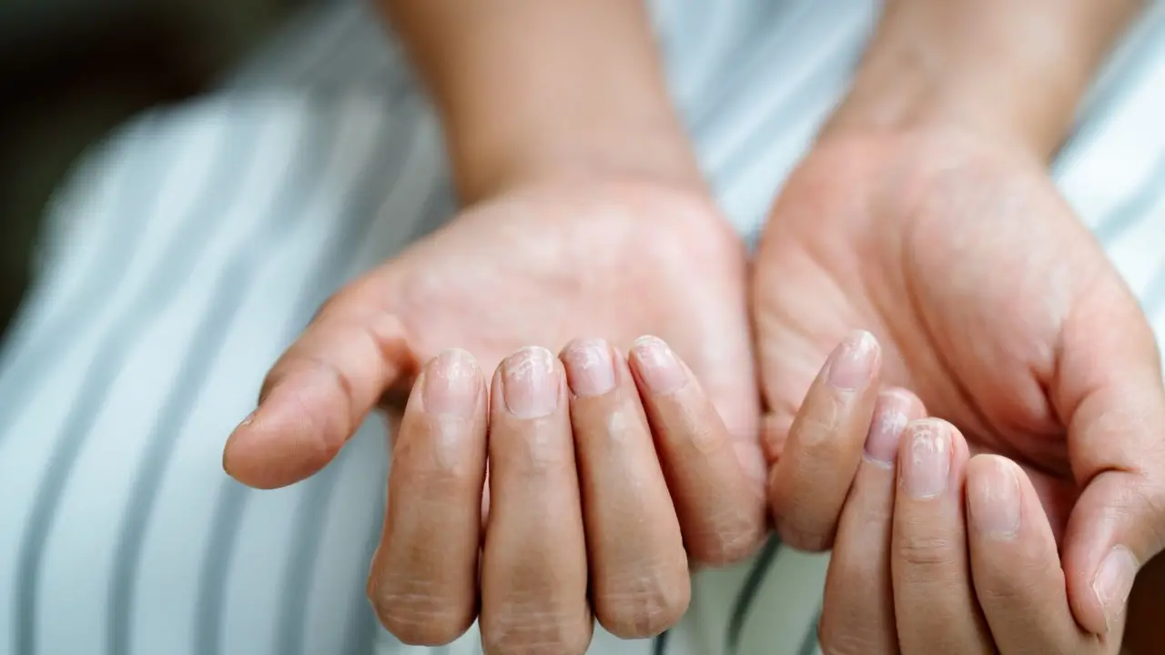 Scopri come alcune spezie comuni possono aumentare il rischio di gonfiore alle mani